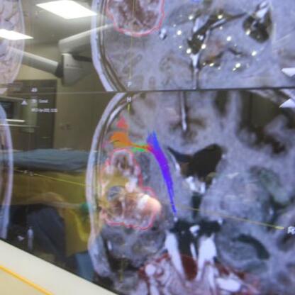 MRI images displayed on a computer screen, part of a glioblastoma treatment project at Wojewódzki Szpital Specjalistyczny nr 5 im. św. Barbary in Sosnowiec, Poland. (wygenerowano przez AI)